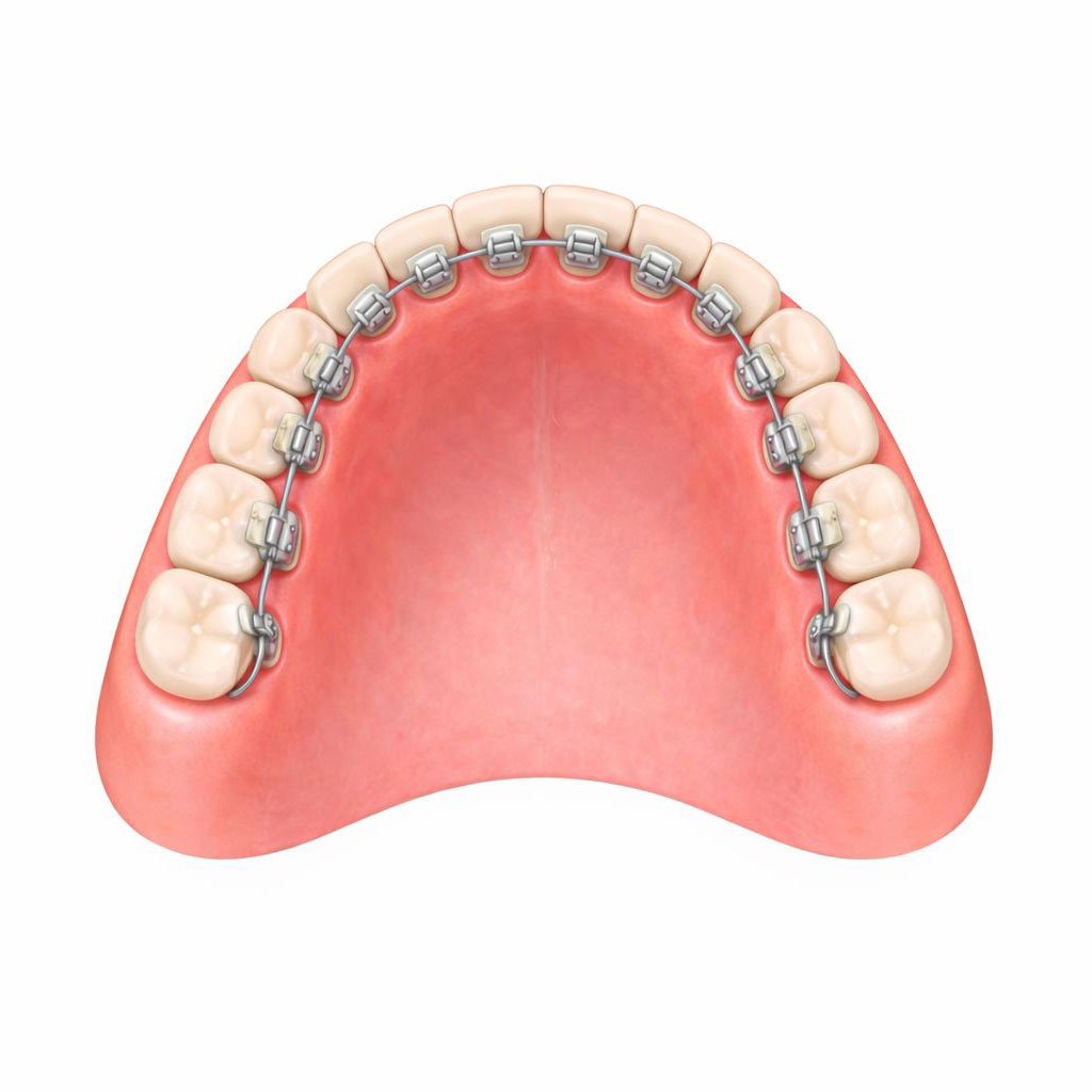 Innenliegende Lingualtechnik